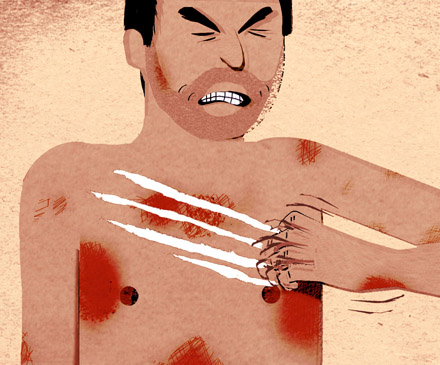 eczema